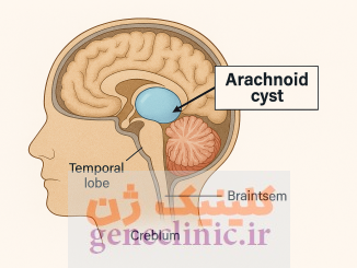 کیست آراکنویید ، Arachnoid cyst