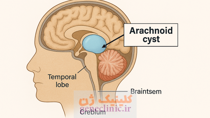 کیست آراکنویید ، Arachnoid cyst کیست آراکنویید ، Arachnoid cyst