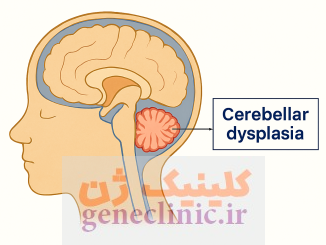دیسپلازی مخچه، ناهنجاری مادرزادی مغز