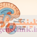 ‏کیست شبکه کوروئید‏، Choroid plexus cysts