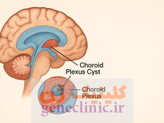 ‏کیست شبکه کوروئید‏، Choroid plexus cysts