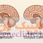 آژنزی کورپوس کالوزوم ، Corpus callosum agenesis