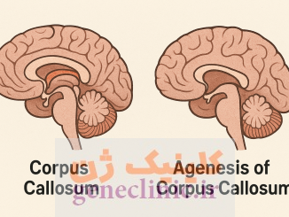 آژنزی کورپوس کالوزوم ، Corpus callosum agenesis