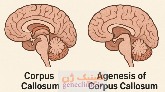 آژنزی کورپوس کالوزوم ، Corpus callosum agenesis آژنزی کورپوس کالوزوم ، Corpus callosum agenesis