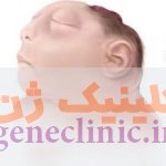 آکرانیا، عدم تشخیص جمجمه