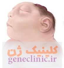 آکرانیا، عدم تشخیص جمجمه