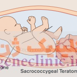 ‏تراتوم ساکروکوکسیژال‏ (Sacrococcygeal teratoma) چیست؟