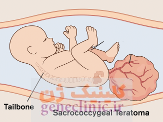 ‏تراتوم ساکروکوکسیژال‏ (Sacrococcygeal teratoma) چیست؟