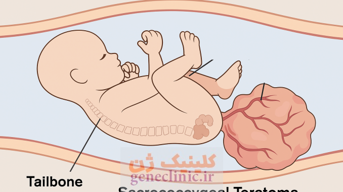 ‏تراتوم ساکروکوکسیژال‏ (Sacrococcygeal teratoma) چیست؟