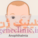 آنوفتالمی‏ (Anophthalmia) چیست؟