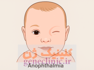 آنوفتالمی‏ (Anophthalmia) چیست؟