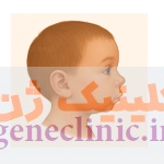 میکروگناتیا‏ (Micrognathia) چیست؟