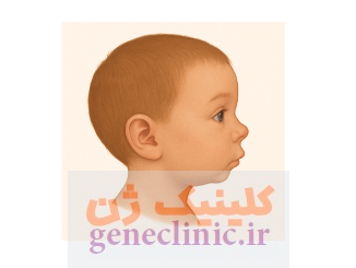میکروگناتیا‏ (Micrognathia) چیست؟
