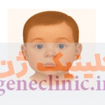 هیپوتلوریسم‏ (Hypotelorism) چیست؟