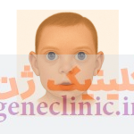 هایپرتلوریسم‏ (Hypertelorism) چیست؟