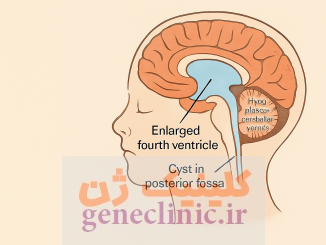 ناهنجاری دندی واکر ،Dandy-Walker malformation