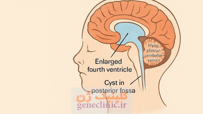 ناهنجاری دندی واکر ، Dandy-Walker malformation ناهنجاری دندی واکر ،Dandy-Walker malformation