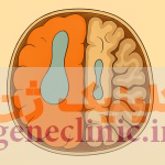 ‏همی مگالنسفالی‏، Hemimegalencephaly