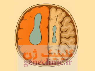 ‏همی مگالنسفالی‏، Hemimegalencephaly
