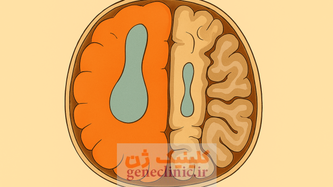 همی مگالنسفالی، Hemimegalencephaly همی مگالنسفالی، Hemimegalencephaly