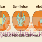 ‏هولوپروزنسفالی، ‏ Holoprosencephaly