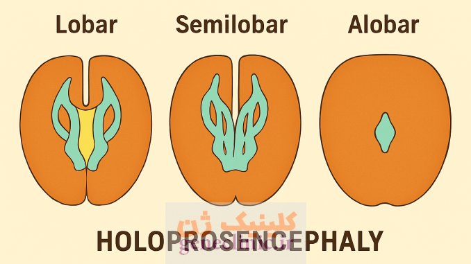 هولوپروزنسفالی، Holoprosencephaly هولوپروزنسفالی، Holoprosencephaly