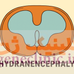 هیدرانسفالی،‏ Hydranencephaly