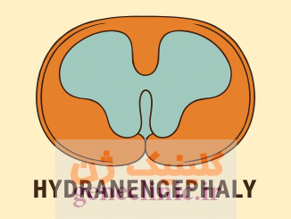 هیدرانسفالی،‏ Hydranencephaly