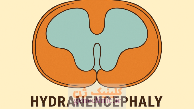 هیدرانسفالی،‏ Hydranencephaly
