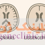 لیسنسفالی‏، Lissencephaly