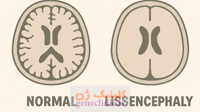 لیسنسفالی، Lissencephaly لیسنسفالی، Lissencephaly