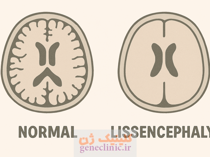لیسنسفالی‏، Lissencephaly