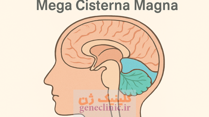 مگاسیسترنا مگنا، Megacisterna magna مگاسیسترنا مگنا، Megacisterna magna