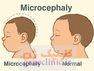 میکروسفالی،Microcephaly