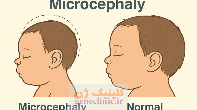 میکروسفالی،Microcephaly میکروسفالی،Microcephaly