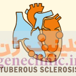 توبروس اسکلروزیس (Tuberous sclerosis) چیست؟