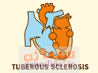 توبروس اسکلروزیس (Tuberous sclerosis) چیست؟