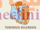 توبروس اسکلروزیس (Tuberous sclerosis) چیست؟