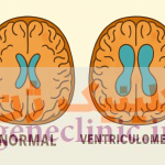 ‏ونتریکولومگالی‏ (Ventriculomegaly) چیست؟