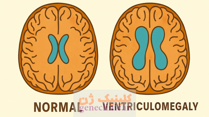 ‏ونتریکولومگالی‏ (Ventriculomegaly) چیست؟