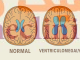 ‏ونتریکولومگالی‏ (Ventriculomegaly) چیست؟