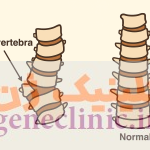 همی ورتبرا یا نیم مهره (Hemivertebra) چیست؟