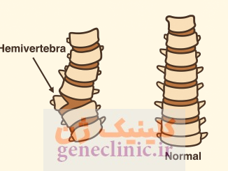 همی ورتبرا یا نیم مهره (Hemivertebra) چیست؟