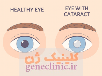 ‏آب مروارید‏ یا کاتاراکت (Cataract) چیست؟
