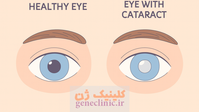 ‏آب مروارید‏ یا کاتاراکت (Cataract) چیست؟