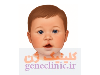 شکاف کام یا لب (Cleft lip or palate) چیست؟