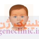 اپیگناتوس‏ (Epignathus) چیست؟