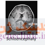 اسکیزانسفالی‏ یا شیزنسفالی (Schizencephaly) چیست؟