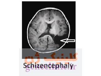اسکیزانسفالی‏ یا شیزنسفالی (Schizencephaly) چیست؟