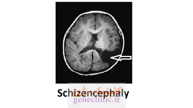 اسکیزانسفالی‏ یا شیزنسفالی (Schizencephaly) چیست؟
